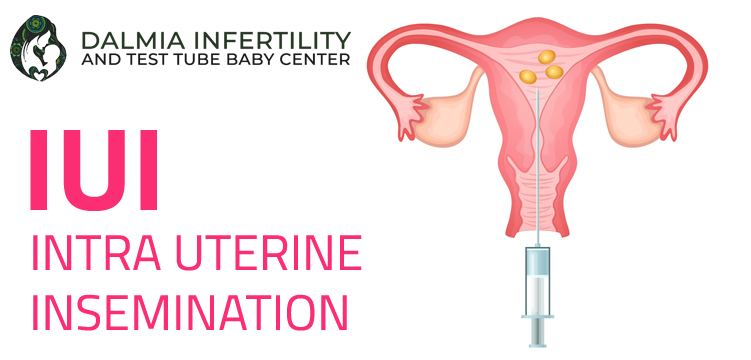 INTRAUTERINE INSEMINATION